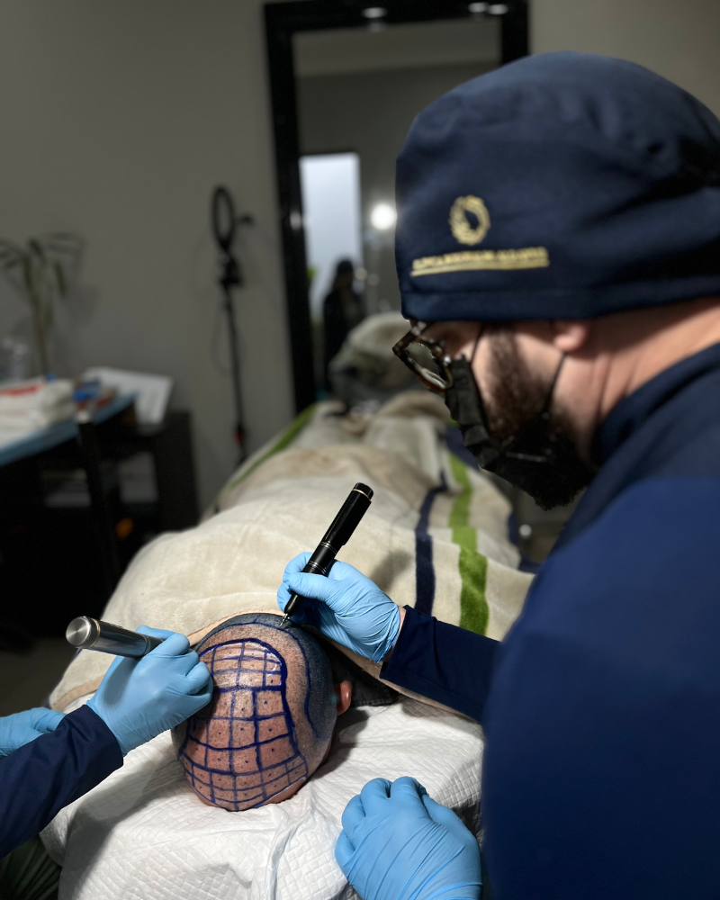 Remoção de Estrias